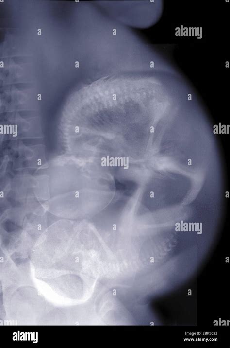 Pregnant Woman With Twins X Ray Stock Photo Alamy