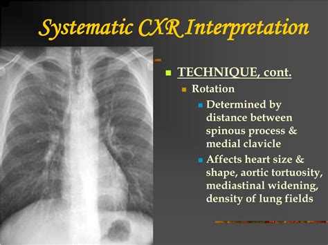 Ppt Chest X Ray Review Powerpoint Presentation Free Download Id172434