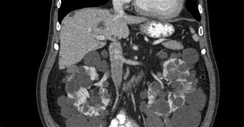 What Is A Ct Scan With Contrast Of The Abdomen