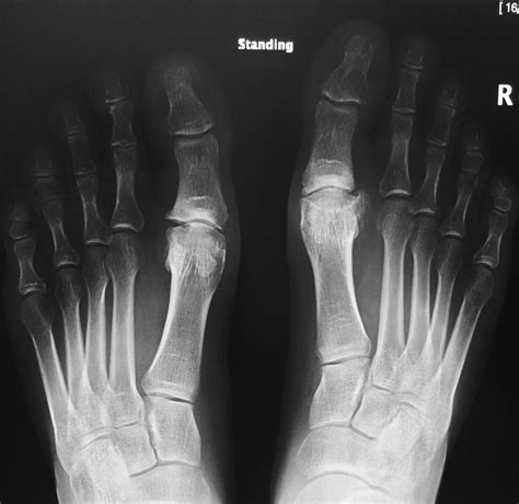 Big Toe Arthritis Arthritis Treatment And Surgery David Redfern