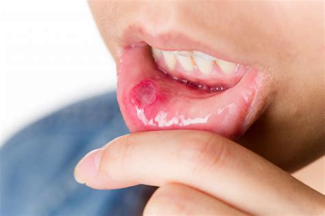tips to treat mouth sores canker or aphthous ulcer expressions dental™