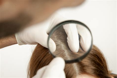 what causes a dry scalp and hair loss