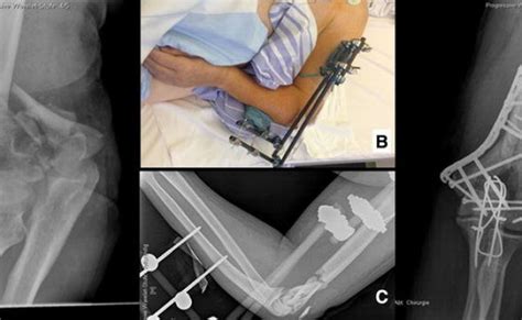 Humerus Distal Fracture 13c3 Fixation With Va Lcp Distal Humerus Plates