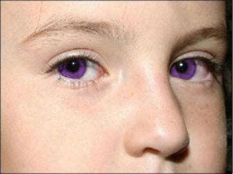 Does Alexandrias Genesis Exist Rare Eyes Rare Eye Colors Eye