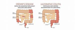 Crohn 39 S And Colitis What Exactly Is The Distinction