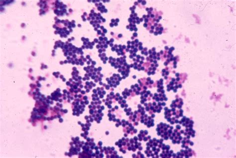 What diseases are caused by staphylococcus aureus? Pin on Staph Aureus Gram stain