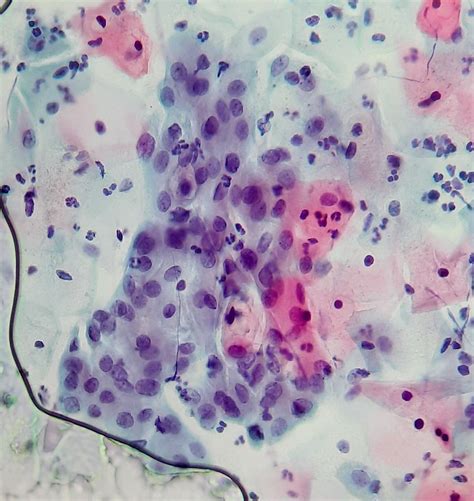 Metaplasia escamosa Placa de células metaplásicas dispuest Flickr