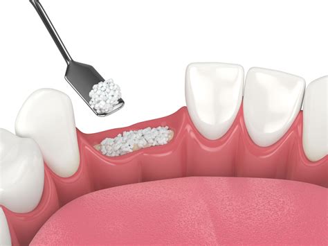 How Bone Grafting Prepares You For Dental Implants Smile Blog