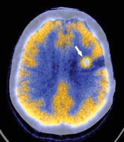 Radiologist diagnosed intraosseous lipoma with no follow up advised. Introduction to Nuclear Medicine | Radiology Key