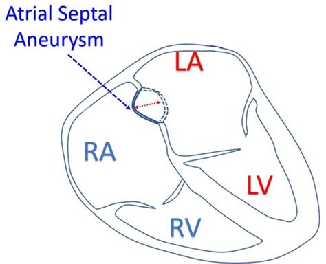 Atrial Septal Aneurysm All About Cardiovascular System And Disorders
