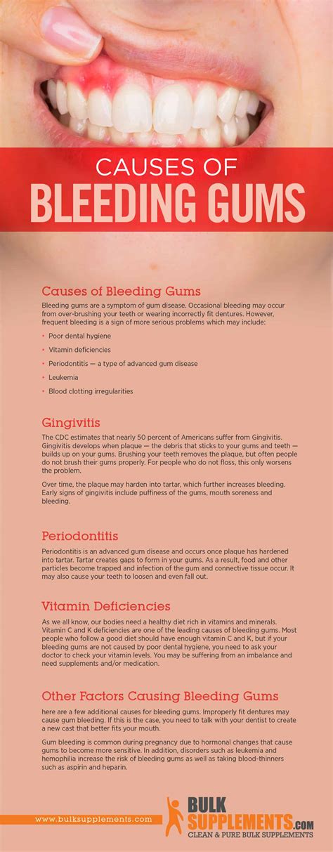Tablo Read Bleeding Gums Characteristics Causes And Treatment By