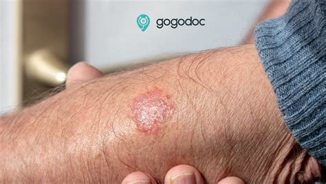 Eczema Causes Symptoms And Treatments General Practice Private