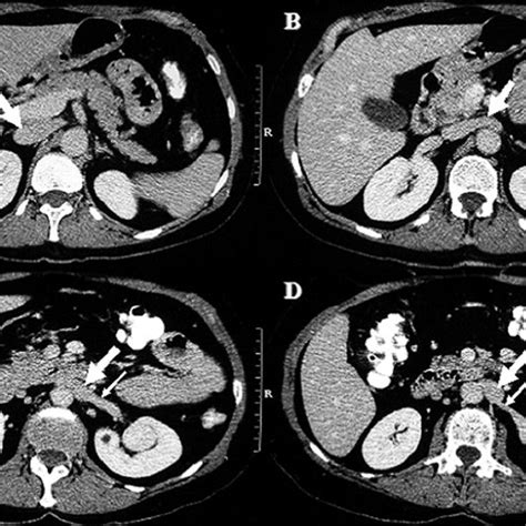 Abdominal Ct Scan Illustrates The Ivc As It Courses From The Normal