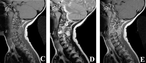 Figure 1 From Aneurysmal Bone Cyst Of The Cervical Spine Semantic Scholar