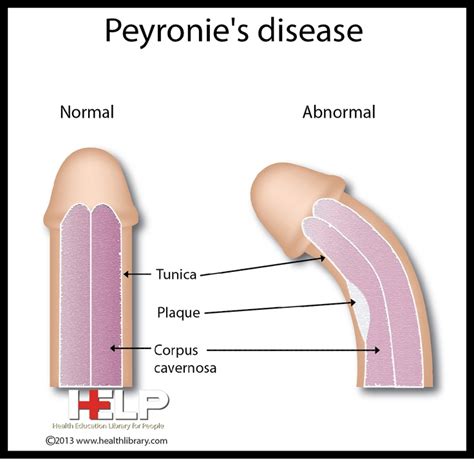 Peyronies Disease Male Reproductive System Pinterest Reproductive System