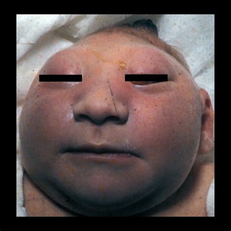 Anencephaly Pediatric Radiology Reference Article Pediatric Imaging Pedsimaging