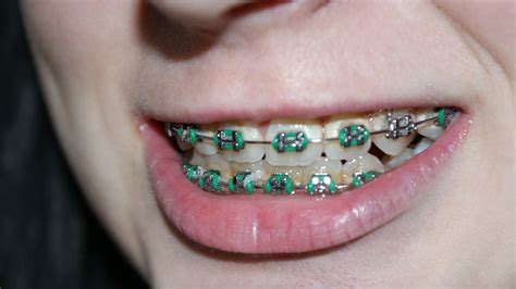 Bands for an overbite start further forward in the mouth, near the canines, on the top of the mouth. Braces Rubber Bands - Purpose, Effects, Downsides, Results