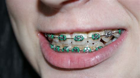 This is what rubber bands do. Braces Rubber Bands - Purpose, Effects, Downsides, Results