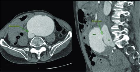 Abdominal Ct With Iv Contrast Demonstrating A Large Infrarenal Aaa