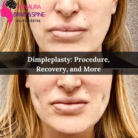 Sab Clinic Dimpleplasty Procedure Recovery And More Issuewire