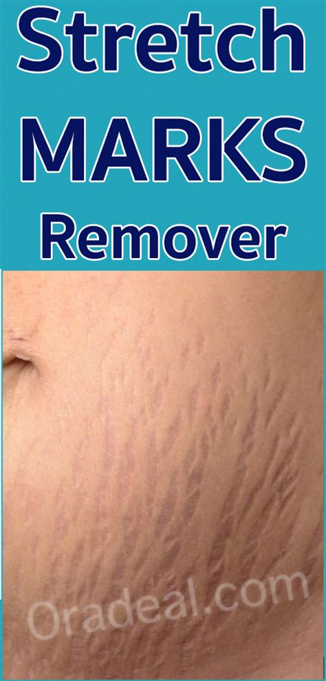 Best Stretch Marks Removal Stretch Marks Brown Spots On Skin How To