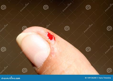 Blood Crack On The Thumb Burr On The Skin Stock Photo Image Of