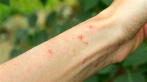 When To Worry About A Rash In Adults