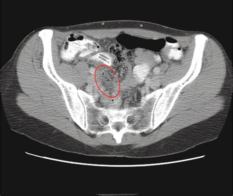 Acute Appendicitis Gastrointestinal Emergencies Tintinallis