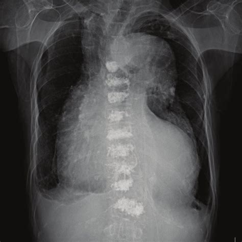 Chest Computed Tomography Showed An Enlarged Thoracic Aorta With An
