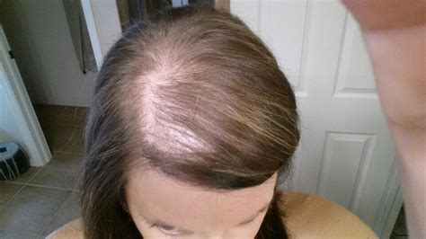 Postpartum Hair Loss Symptoms Causes Treatment Home Remedies Stages Healthmd