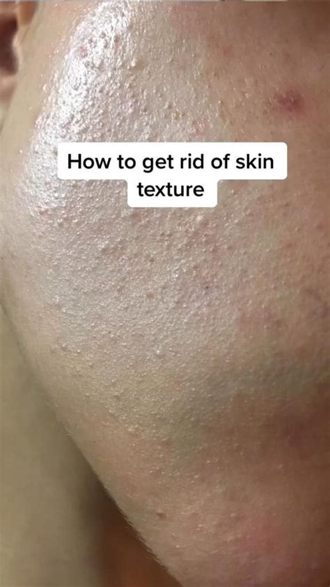 How To Get Rid Of Skin Texture Pinterest