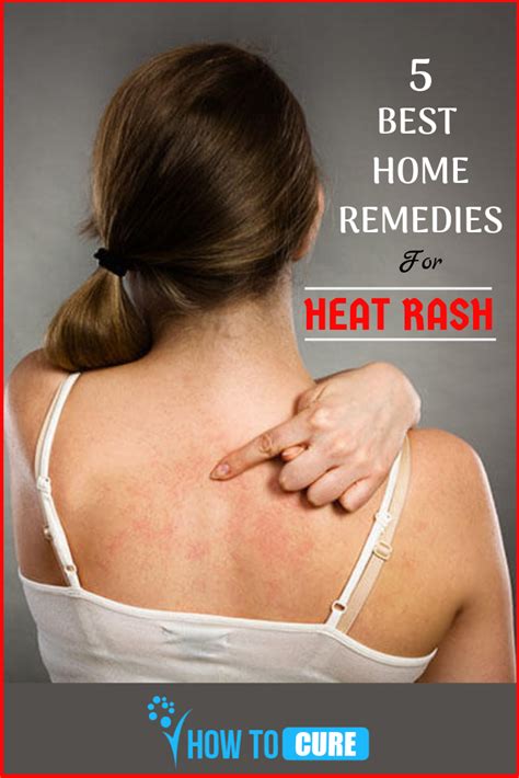 5 Effective Home Remedies For Heat Rash Howtocure Heat Rash Heat
