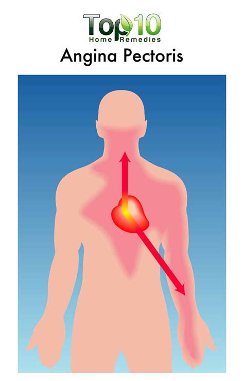 Diagram showing the placement of the 6 chest leads. Home Remedies for Chest Pain (Angina) | Top 10 Home Remedies