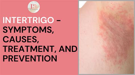 what are intertrigo symptoms and causes rakshaa clinic medium