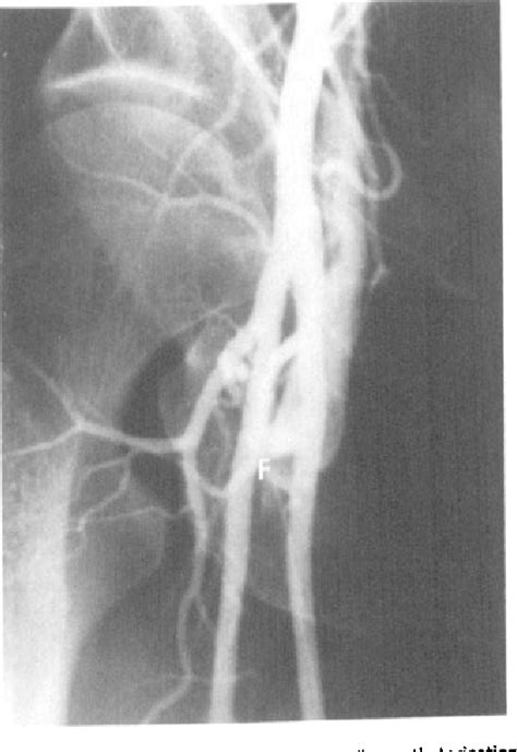 Figure 1 From Femoral Arteriovenous Fistula Following Cardiac