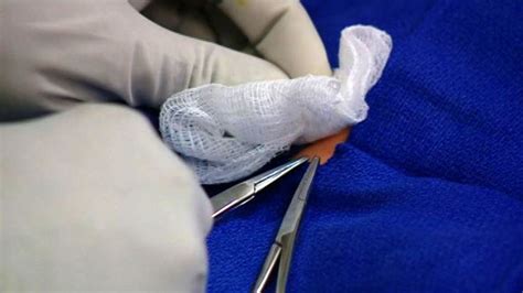 A Doctor S Guide To Male Circumcision Bbc News