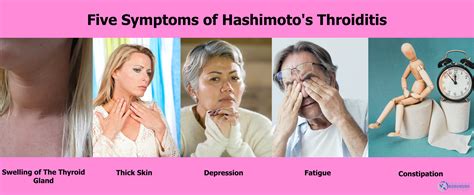 5 Symptoms Of Hashimotos Thyroid