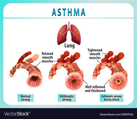 Bronchial Asthma Diagram With Normal Airway Vector Image The Best