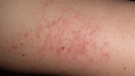 Skin Disorders Pictures Causes Symptoms Treatments