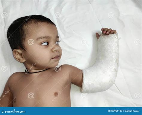 Little Child With Broken Or Fractured Arm With Plaster Bandage On White