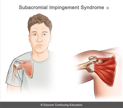 Unit Subacromial Impingement Syndrome Lifewest S U Pd