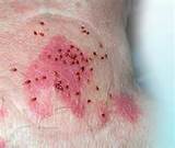 Images of Does Bed Bug Spray Kill Scabies