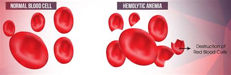 Hemolytic Anemia Blood Smear