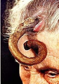 Cutaneous horn is a clinical diagnosis referring to a conical projection of cornified material above the surface of the skin that resembles a miniature horn. Extreme  Humans + Creativities + Secrets : Cutaneous ...