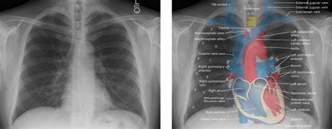 Anatomy Of Chest X Ray X Thorax Startradiology It First Appears Too