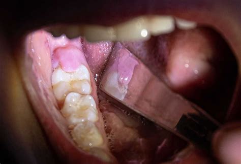 Gum Flap Over Wisdom Tooth Everything You Need To Know