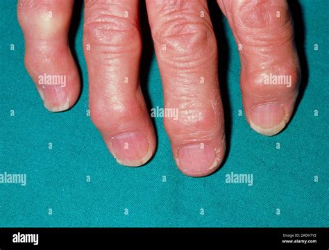 Heberden S Node On Fingers A Hand Affected By Osteoarthritis Showing Heberden S Nodes A Ring