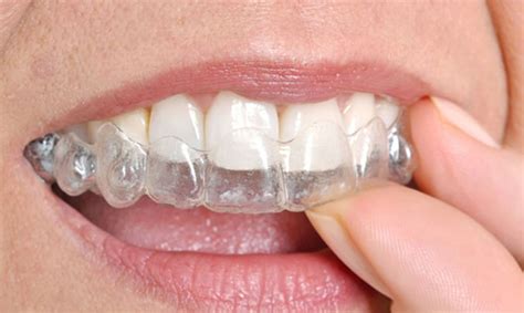 Effaf Plak Tedavisi Telsiz Ortodontik Tedavi Periodent