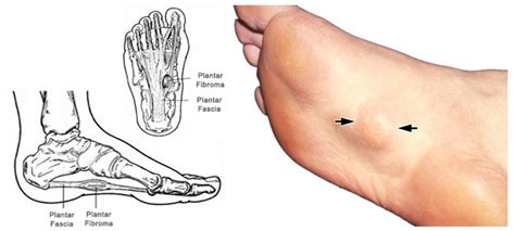 It hurts mildly when i try rubbing it witm my hand, and sometimes i feel a little pain when i'm they are very common on the top of the foot and in most cases are a result of friction from a shoe rubbing on the tendon. Painful Lump on Bottom of Foot | Family Foot & Ankle ...