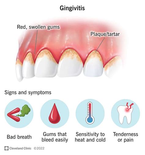 Gingivitis Symptoms How To Treat It